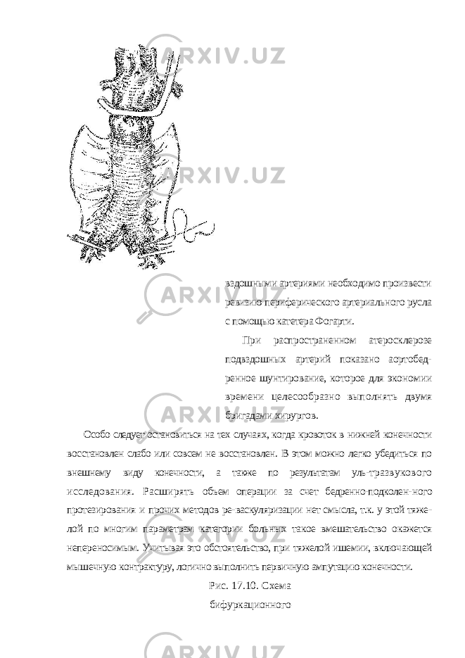 вздошными артериями необходимо произ вести ревизию периферического артериаль ного русла с помощью катетера Фогарти. При распространенном атеросклерозе подвздошных артерий показано аортобед- ренное шунтирование, которое для эконо мии времени целесообразно выполнять двумя бригадами хирургов. Особо следует остановиться на тех случа ях, когда кровоток в нижней конечности вос становлен слабо или совсем не восстановлен. В этом можно легко убедиться по внешнему виду конечности, а также по результатам уль- тразвукового исследования. Расширять объем операции за счет бедренно-подколен- ного протезирования и прочих методов ре- васкуляризации нет смысла, т.к. у этой тяже - лой по многим параметрам категории боль ных такое вмешательство окажется непере носимым. Учитывая это обстоятельство, при тяжелой ишемии, включающей мышечную контрактуру, логично выполнить первичную ампутацию конечности. Рис. 17.10. Схема бифуркационного 