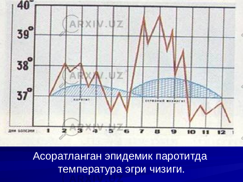 Асоратланган эпидемик паротитда температура эгри чизиги. 