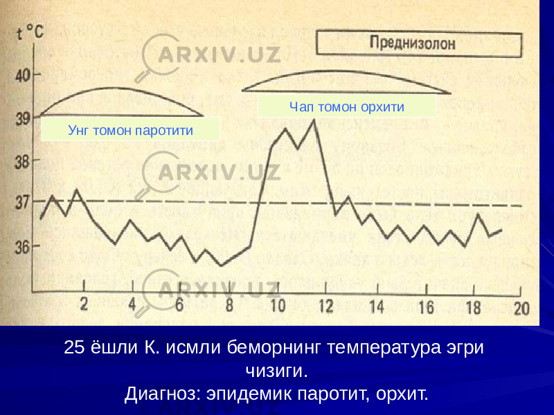 25 ёшли К. исмли беморнинг температура эгри чизиги. Диагноз: эпидемик паротит, орхит.Унг томон паротити Чап томон орхити 