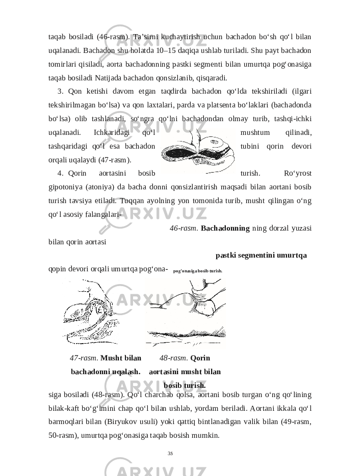 taqab bosiladi (46-rasm). Ta’sirni kuchaytirish uchun bachadon bo‘sh qo‘l bilan uqalanadi. Bachadon shu holatda 10–15 daqiqa ushlab turiladi. Shu payt bachadon tomirlari qisiladi, aorta bachadonning pastki segmenti bilan umurtqa pog‘onasiga taqab bosiladi Natijada bachadon qonsizlanib, qisqaradi. 3. Qon ketishi davom etgan taqdirda bachadon qo‘lda tekshiriladi (ilgari tekshirilmagan bo‘lsa) va qon laxtalari, parda va platsenta bo‘laklari (bachadonda bo‘lsa) olib tashlanadi, so‘ngra qo‘lni bachadondan olmay turib, tashqi-ichki uqalanadi. Ichkaridagi qo‘l mushtum qilinadi, tashqaridagi qo‘l esa bachadon tubini qorin devori orqali uqalaydi (47-rasm). 4. Qorin aortasini bosib turish. Ro‘yrost gipotoniya (atoniya) da bacha donni qonsizlantirish maqsadi bilan aortani bosib turish tavsiya etiladi. Tuqqan ayolning yon tomonida turib, musht qilingan o‘ng qo‘l asosiy falangalari- 46-rasm. Bachadonning ning dorzal yuzasi bilan qorin aortasi pastki segmentini umurtqa qopin devori orqali umurtqa pog‘ona- pog’onasiga bosib turish. 47-rasm. Musht bilan bachadonni uqalash. 48-rasm. Qorin aortasini musht bilan bosib turish. siga bosiladi (48-rasm). Qo‘l charchab qolsa, aortani bosib turgan o‘ng qo‘lining bilak-kaft bo‘g‘imini chap qo‘l bilan ushlab, yordam beriladi. Aortani ikkala qo‘l barmoqlari bilan (Biryukov usuli) yoki qattiq bintlanadigan valik bilan (49-rasm, 50-rasm), umurtqa pog‘onasiga taqab bosish mumkin. 35 