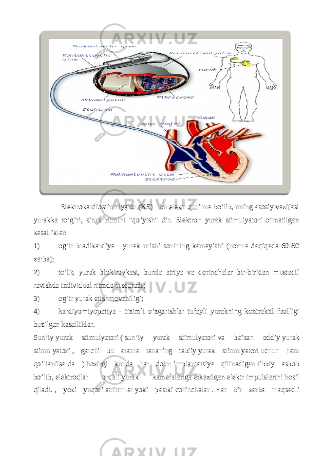  Elektrokardiostimulyator (KS) - bu elektr qurilma bo’lib, uning asosiy vazifasi yurakka to’g’ri, sinus ritmini &#34;qo’yish&#34; dir. Elektron yurak stimulyatori o’rnatilgan kasalliklar: 1) og’ir bradikardiya - yurak urishi sonining kamayishi (norma daqiqada 60-80 zarba); 2) to’liq yurak blokirovkasi, bunda atriya va qorinchalar bir-biridan mustaqil ravishda individual ritmda qisqaradi; 3) og’ir yurak etishmovchiligi; 4) kardiyomiyopatiya - tizimli o ’ zgarishlar tufayli yurakning kontraktil faolligi buzilgan kasalliklar . Sun ’ iy   yurak stimulyatori   (   sun ’ iy yurak stimulyatori   va ba ’ zan oddiy   yurak stimulyatori   , garchi bu atama tananing tabiiy   yurak stimulyatori   uchun ham qo ’ llanilsa - da )   hozirgi kunda har doim   implantatsiya qilinadigan   tibbiy asbob bo ’ lib ,   elektrodlar orqali   yurak kameralariga   etkazilgan   elektr   impulslarini   hosil qiladi .   , yoki yuqori   atriumlar   yoki pastki   qorinchalar   .   Har bir zarba maqsadli 