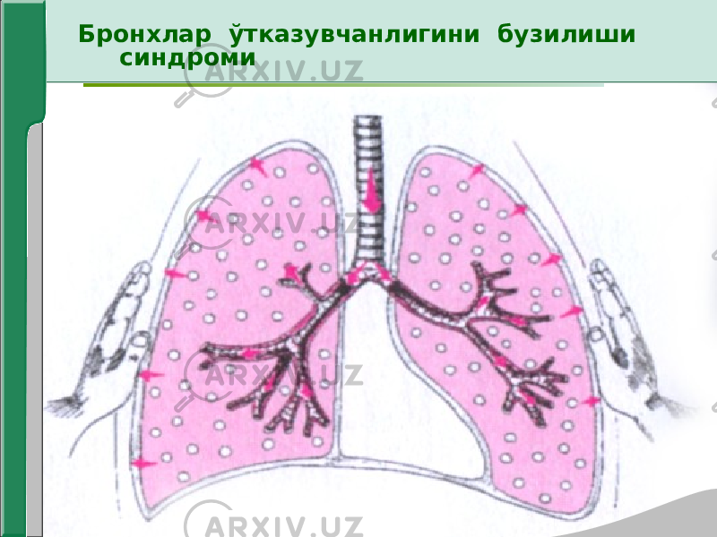 Бронхлар ўтказувчанлигини бузилиши синдроми 