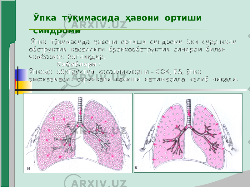 Ўпка тўқимасида ҳавони ортиши синдроми Ўпка тўқимасида ҳавони ортиши синдроми ёки сурункали обструктив касаллиги бронхообструктив синдром билан чамбарчас боғлиқдир. Сабаблари : Ўпкада обструктив касалликларни – СОК, БА, ўпка эмфиземаси – сурункали кечиши натижасида келиб чиқади. 