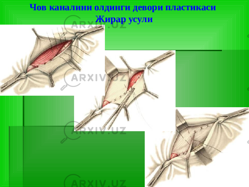 Чов каналини олдинги девори пластикаси Жирар усули 