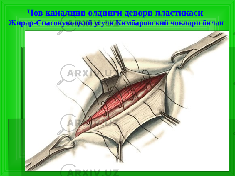 Чов каналини олдинги девори пластикаси Жирар-Спасокукоцкий усули Кимбаровский чоклари билан 