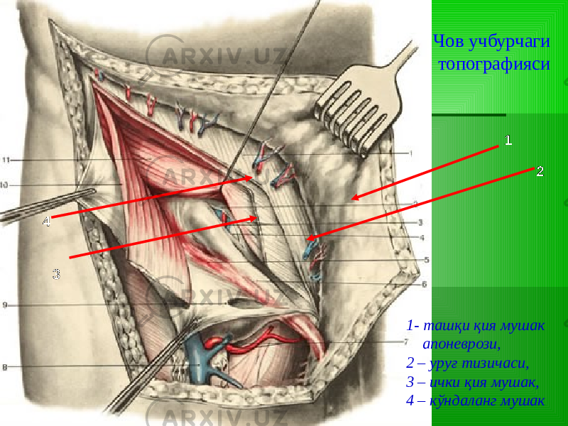 4 1 2 3 1- ташқи қия мушак апоневрози, 2 – уруғ тизичаси, 3 – ички қия мушак, 4 – кўндаланг мушак Чов учбурчаги топографияси 