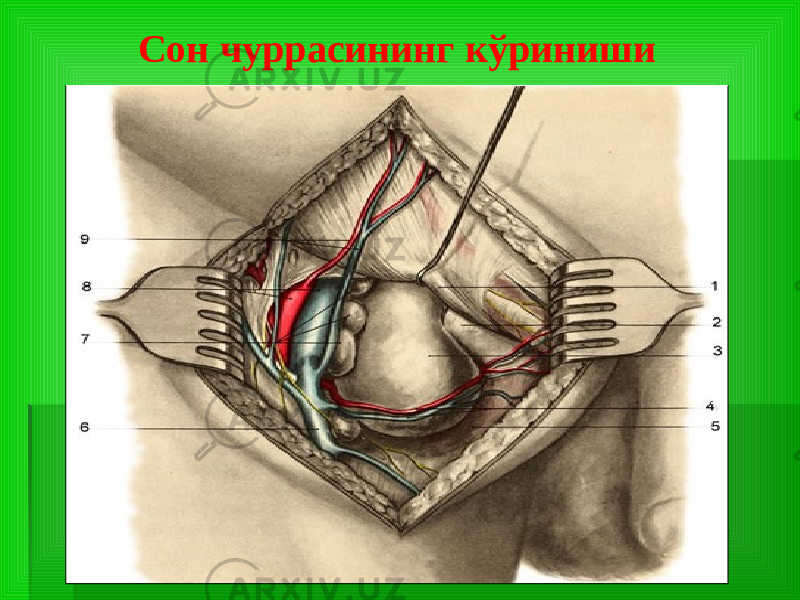 Сон чуррасининг кўриниши 