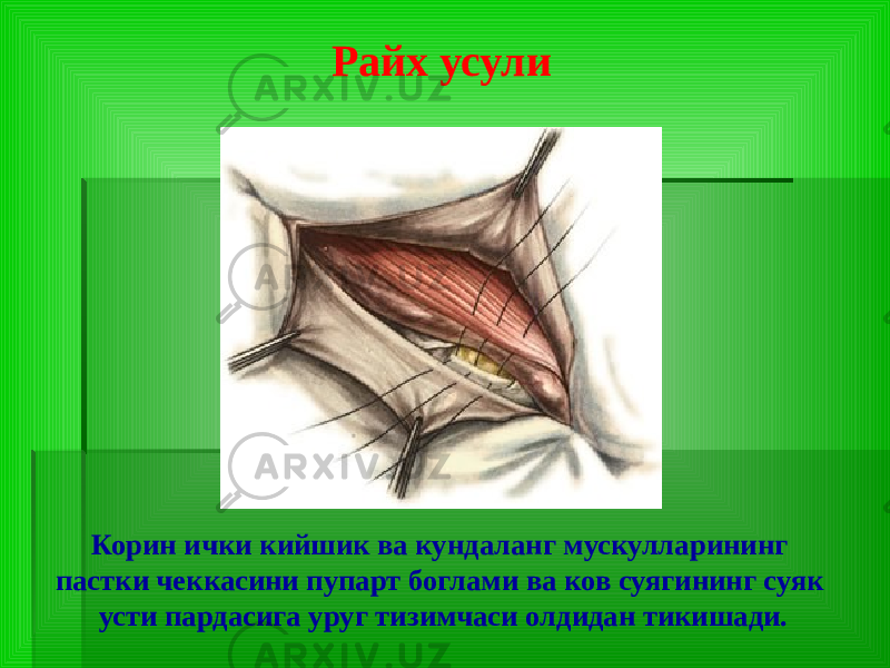 Райх усули Корин ички кийшик ва кундаланг мускулларининг пастки чеккасини пупарт боглами ва ков суягининг суяк усти пардасига уруг тизимчаси олдидан тикишади. 