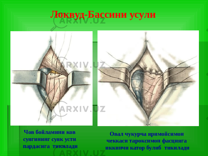 Локвуд-Бассини усули Чов бойламини ков суягининг суяк усти пардасига тикилади Овал чукурча яримойсимон чеккаси тароксимон фасцияга иккинчи катор булиб тикилади 