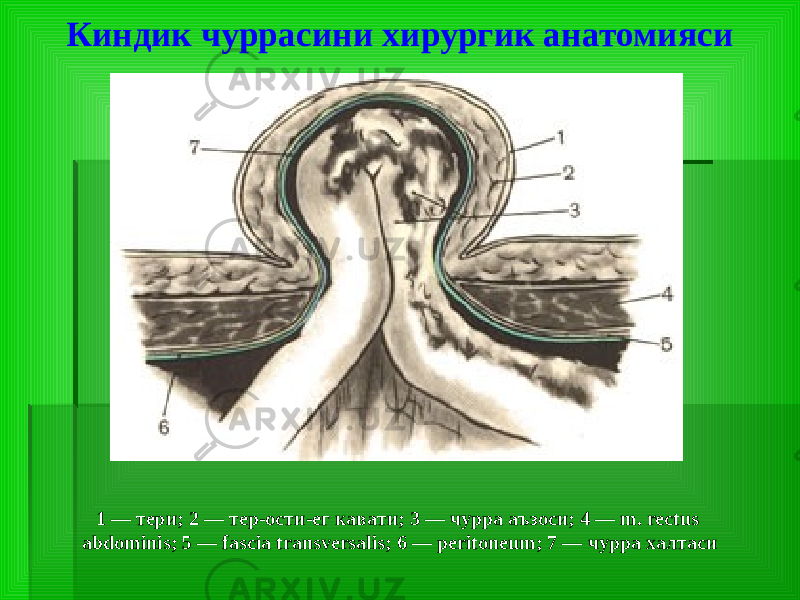 Киндик чуррасини хирургик анатомияси 1 — тери; 2 — тер-ости-ег кавати; 3 — чурра аъзоси; 4 — m. rectus abdominis; 5 — fascia transversalis; 6 — peritoneum; 7 — чурра халтаси 