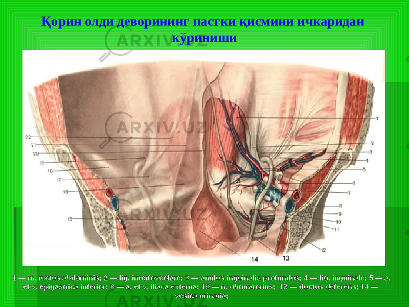 Қорин олди деворининг пастки қисмини ичкаридан кўриниши 1 — m. rectus abdominis; 2 — lig. interfoveolare; 3 — anulus inguinalis profundus; 4 — lig. inguinale; 5 — a. et v. epigastrica inferior; 8 — a. et v. iliaca externa; 10 — n. obturatorius; 13 — ductus deferens; 14 — vesica urinaria; 