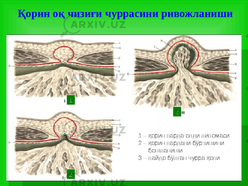 Қорин оқ чизиғи чуррасини ривожланиши 1 – қорин парда олди липомаси 2 – қорин пардани бўртишини бошланиши 3 – пайдо бўлган чурра қопи1 2 3 
