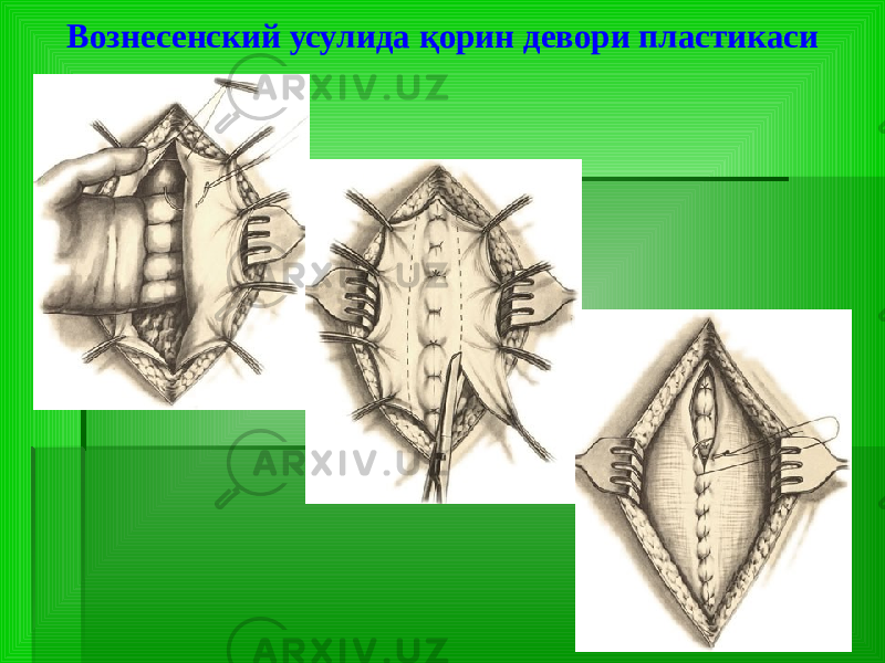 Вознесенский усулида қорин девори пластикаси 