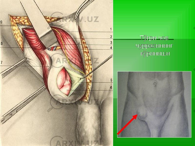 Тўғри чов чуррасининг кўриниши 