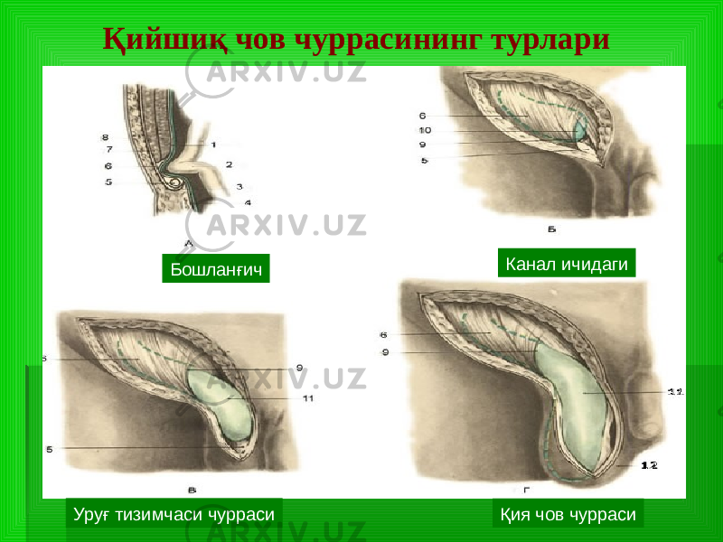 Қийшиқ чов чуррасининг турлари Бошланғич Канал ичидаги Уруғ тизимчаси чурраси Қия чов чурраси 