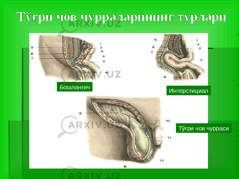 Тўғри чов чурраларининг турлари Бошланғич Интерстициал Тўғри чов чурраси 