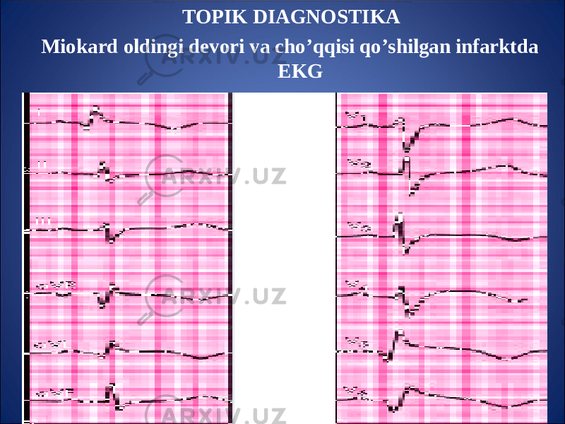 TOPIK DIAGNOSTIKA Miokard oldingi devori va ch o’qq isi qo’ shilgan infarktda EKG 