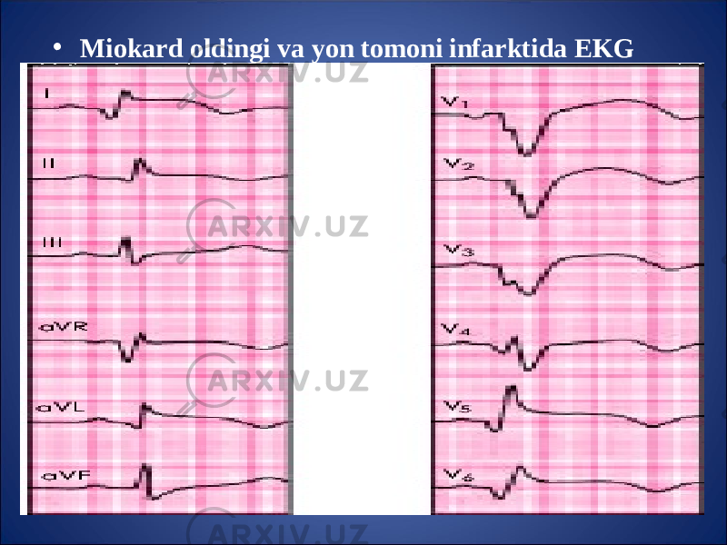 • Miokard oldingi va yon tomoni infarktida EKG 