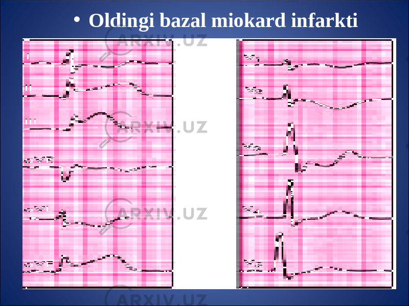 • Oldingi bazal miokard infarkti 