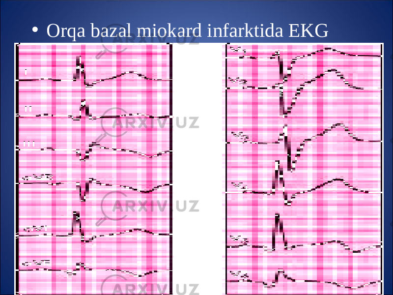 • Or q a bazal miokard infarktida EKG 