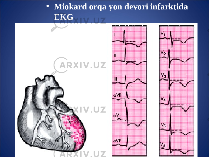 • Miokard or q a yon devori infarktida EKG 