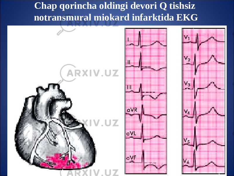 Chap q orincha oldingi devori Q tishsiz notransmural miokard infarktida EKG 