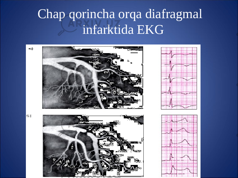 Chap q orincha or q a diafragmal infarktida EKG 