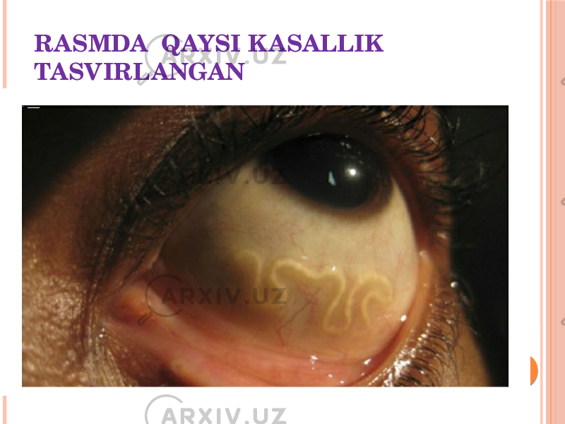 RASMDA QAYSI KASALLIK TASVIRLANGAN 