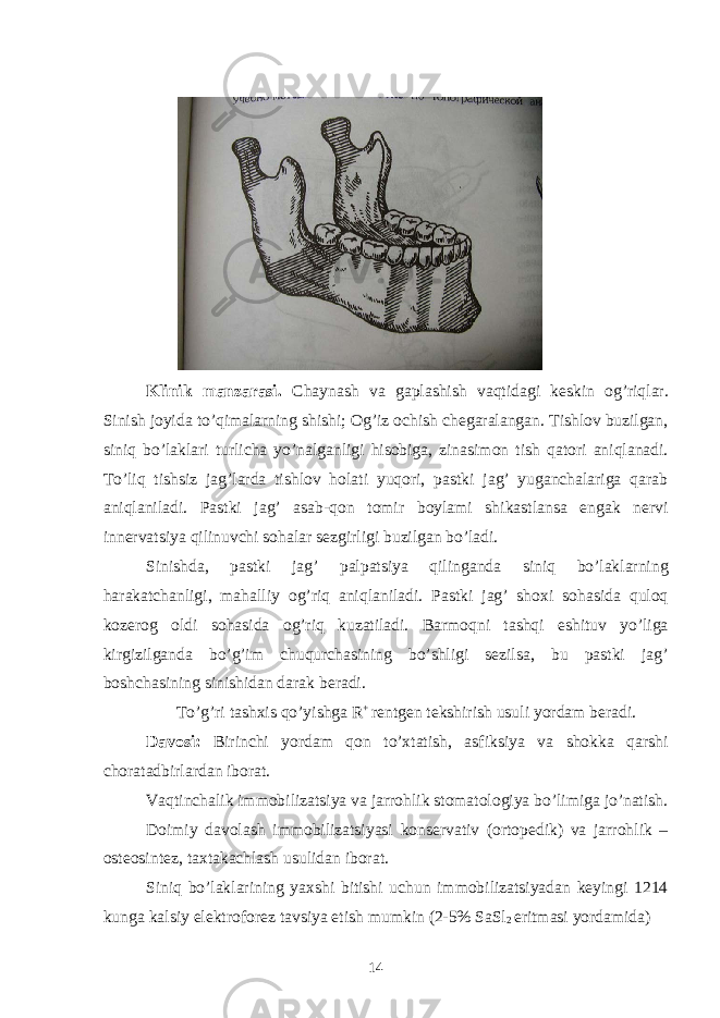  Klinik manzarasi. Chaynash va gaplashish vaqtidagi keskin og’riqlar. Sinish joyida to’qimalarning shishi; Og’iz ochish chegaralangan. Tishlov buzilgan, siniq bo’laklari turlicha yo’nalganligi hisobiga, zinasimon tish qatori aniqlanadi. To’liq tishsiz jag’larda tishlov holati yuqori, pastki jag’ yuganchalariga qarab aniqlaniladi. Pastki jag’ asab-qon tomir boylami shikastlansa engak nervi innervatsiya qilinuvchi sohalar sezgirligi buzilgan bo’ladi. Sinishda, pastki jag’ palpatsiya qilinganda siniq bo’laklarning harakatchanligi, mahalliy og’riq aniqlaniladi. Pastki jag’ shoxi sohasida quloq kozerog oldi sohasida og’riq kuzatiladi. Barmoqni tashqi eshituv yo’liga kirgizilganda bo’g’im chuqurchasining bo’shligi sezilsa, bu pastki jag’ boshchasining sinishidan darak beradi. To’g’ri tashxis qo’yishga R + rentgen tekshirish usuli yordam beradi. Davosi: Birinchi yordam qon to’xtatish, asfiksiya va shokka qarshi choratadbirlardan iborat. Vaqtinchalik immobilizatsiya va jarrohlik stomatologiya bo’limiga jo’natish. Doimiy davolash immobilizatsiyasi konservativ (ortopedik) va jarrohlik – osteosintez, taxtakachlash usulidan iborat. Siniq bo’laklarining yaxshi bitishi uchun immobilizatsiyadan keyingi 1214 kunga kalsiy elektroforez tavsiya etish mumkin (2-5% SaSl 2 eritmasi yordamida) 14 