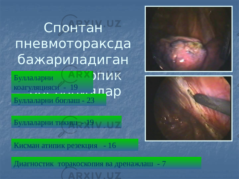 Спонтан пневмотораксда бажариладиган торакоскопик операциялар Буллаларни коагуляцияси - 19 Буллаларни боглаш - 23 Буллаларни тикиш - 19 Кисман атипик резекция - 16 Диагностик торакоскопия ва дренажлаш - 7 