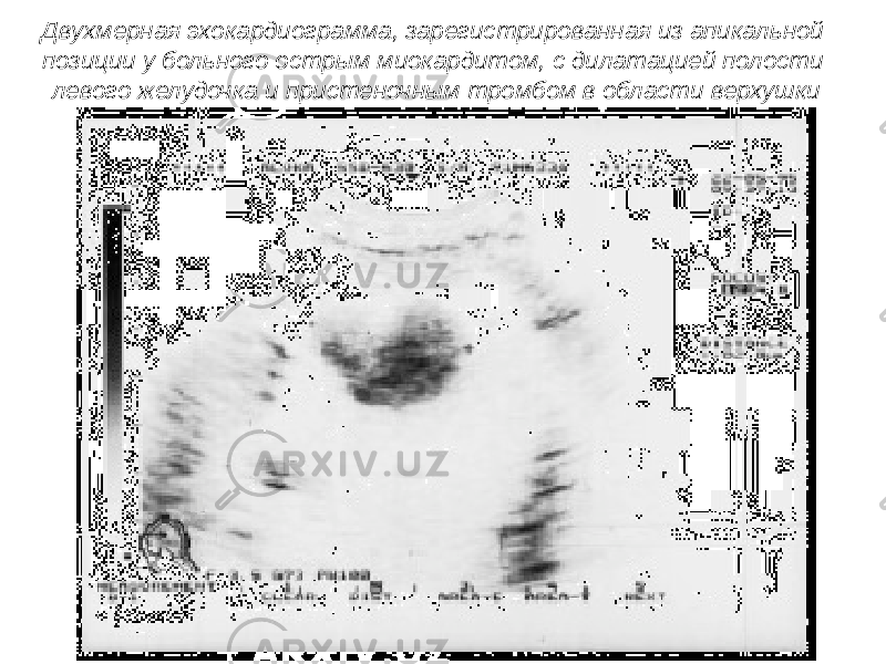 Двухмерная эхокардиограмма, зарегистрированная из апикальной позиции у больного острым миокардитом, с дилатацией полости левого желудочка и пристеночным тромбом в области верхушки 