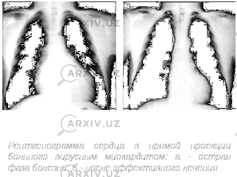 Рентгенограмма сердца в прямой проекции больного вирусным миокардитом: а - острая фаза болезни; б - после эффективного лечения 