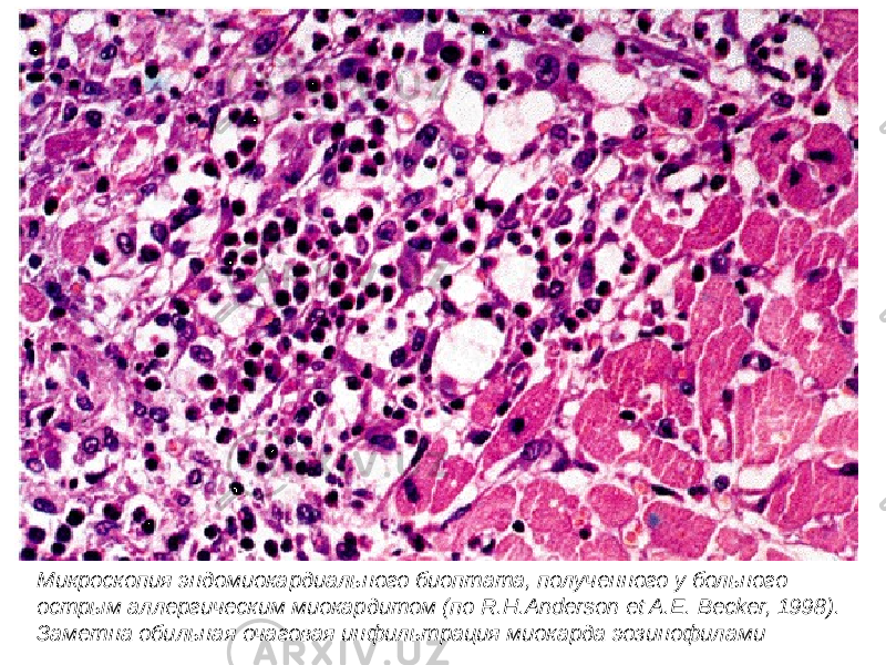 Микроскопия эндомиокардиального биоптата, полученного у больного острым аллергическим миокардитом (по R.H.Anderson et A.E. Becker, 1998). Заметна обильная очаговая инфильтрация миокарда эозинофилами 