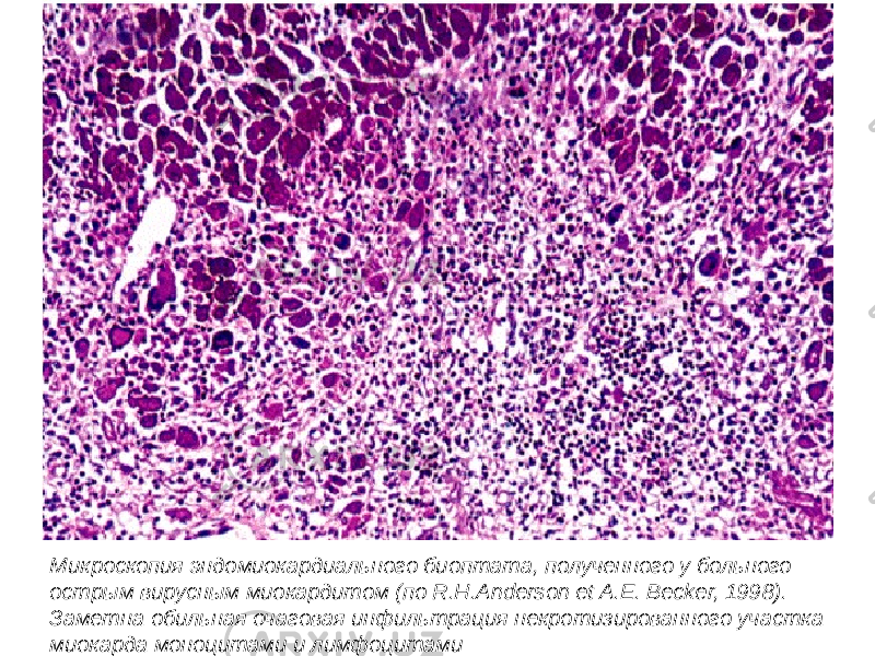 Микроскопия эндомиокардиального биоптата, полученного у больного острым вирусным миокардитом (по R.H.Anderson et A.E. Becker, 1998). Заметна обильная очаговая инфильтрация некротизированного участка миокарда моноцитами и лимфоцитами 