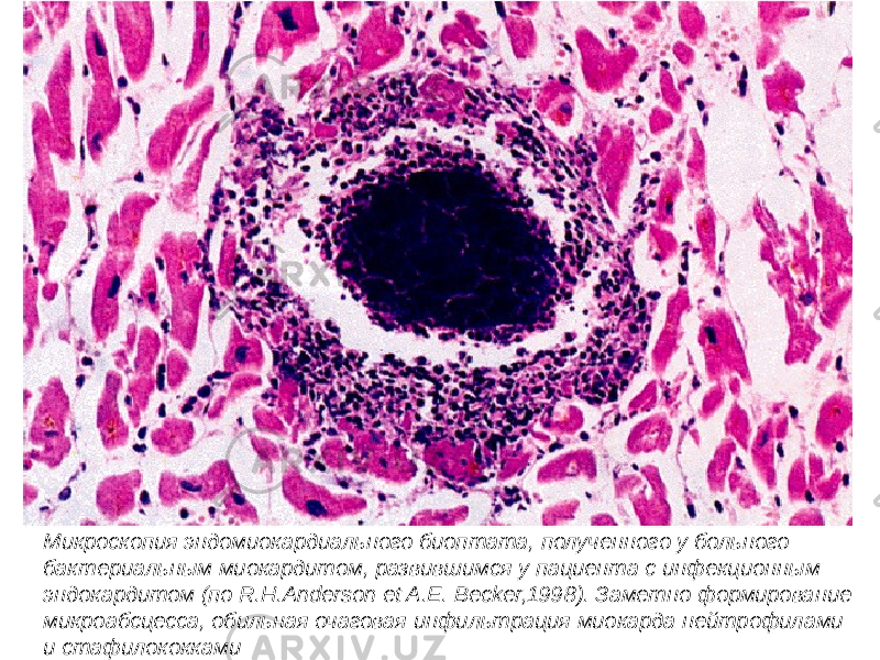 Микроскопия эндомиокардиального биоптата, полученного у больного бактериальным миокардитом, развившимся у пациента с инфекционным эндокардитом (по R.H.Anderson et A.E. Becker,1998). Заметно формирование микроабсцесса, обильная очаговая инфильтрация миокарда нейтрофилами и стафилококками 