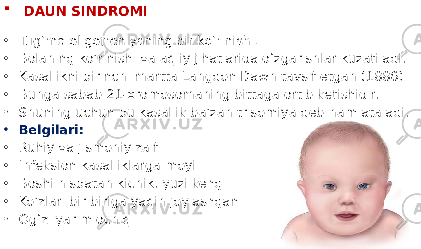  DAUN SINDROMI • Tug’ma oligofreniyaning bir ko’rinishi. • Bolaning ko’rinishi va aqliy jihatlarida o’zgarishlar kuzatiladi. • Kasallikni birinchi martta Langdon Dawn tavsif etgan (1886). • Bunga sabab 21-xromosomaning bittaga ortib ketishidir. • Shuning uchun bu kasallik ba’zan trisomiya deb ham ataladi. • Belgilari: • Ruhiy va jismoniy zaif • Infeksion kasalliklarga moyil • Boshi nisbatan kichik, yuzi keng • Ko’zlari bir biriga yaqin joylashgan • Og’zi yarim ochiq 