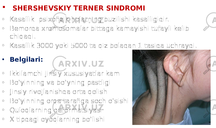  SHERSHEVSKIY TERNER SINDROMI • Kasallik psixofizik holatning buzilishi kasalligidir. • Bemorda xromosomalar bittaga kamayishi tufayli kelib chiqadi. • Kasallik 3000 yoki 5000 ta qiz boladan 1 tasida uchraydi. • Belgilari: • Ikkilamchi jinsiy xususiyatlar kam • Bo’yinning va bo’yning pastligi • Jinsiy rivojlanishda orta qolish • Bo’yinning orqa tarafiga soch o’sishi • Quloqlarning deformatsiyasi • X tipdagi oyoqlarning bo’lishi 