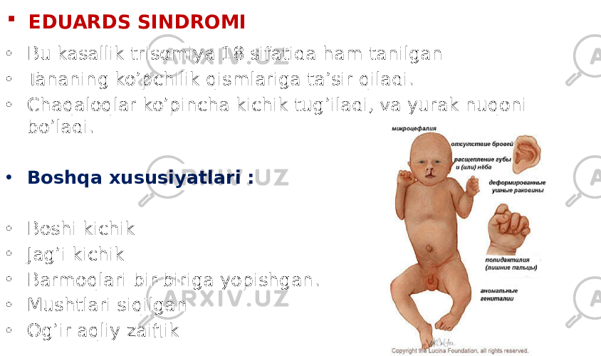  EDUARDS SINDROMI • Bu kasallik trisomiya 18 sifatida ham tanilgan • Tananing ko’pchilik qismlariga ta’sir qiladi. • Chaqaloqlar ko’pincha kichik tug’iladi, va yurak nuqoni bo’ladi. • Boshqa xususiyatlari : • Boshi kichik • Jag’i kichik • Barmoqlari bir-biriga yopishgan. • Mushtlari siqilgan • Og’ir aqliy zaiflik 