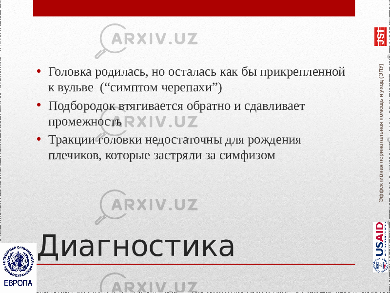 Эффективная перинатальная помощь и уход (ЭПУ)Диагностика• Головка родилась, но осталась как бы прикрепленной к вульве (“симптом черепахи”) • Подбородок втягивается обратно и сдавливает промежность • Тракции головки недостаточны для рождения плечиков, которые застряли за симфизом 