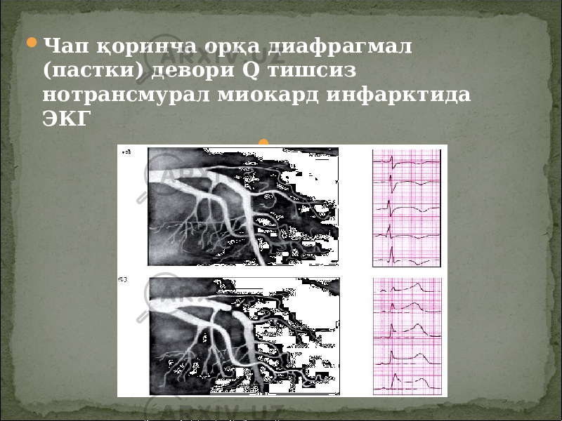  Чап қоринча орқа диафрагмал (пастки) девори Q тишсиз н о трансмурал миокард инфаркт ида ЭКГ  