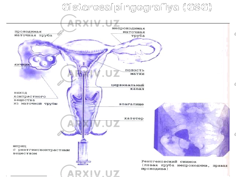  Gistеrosalpingografiya (GSG) 