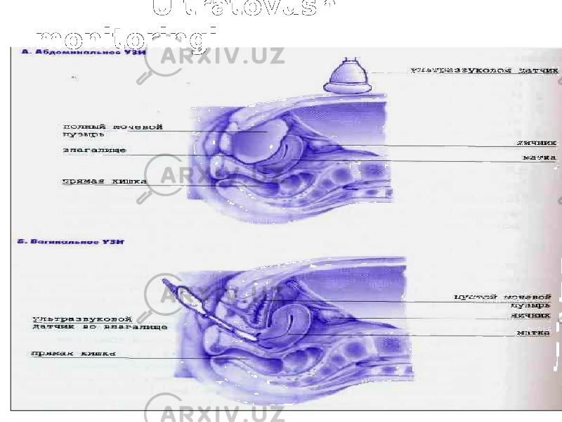  Ultratovush monitoringi 