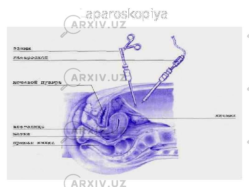 Laparoskopiya 