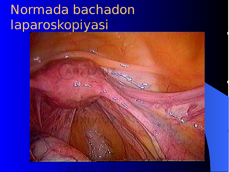 Normada bachadon laparoskopiyasi 