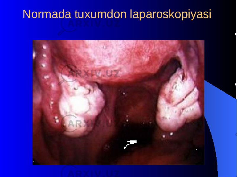  Normada tuxumdon laparoskopiyasi 