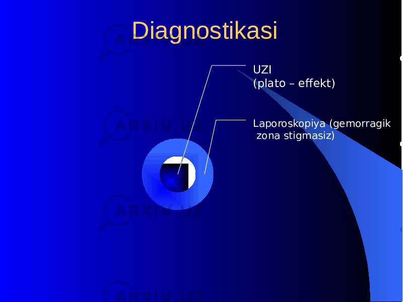  Diagnostikasi Laporoskopiya (gеmorragik zona stigmasiz) UZI (plato – effеkt) 