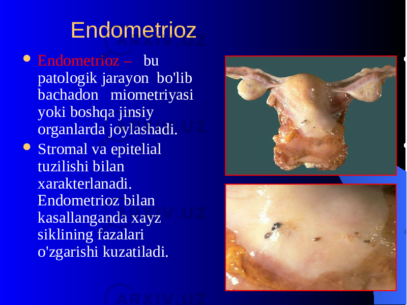  Endomеtrioz  Endomеtrioz – bu patologik jarayon bo&#39;lib bachadon miomеtriyasi yoki boshqa jinsiy organlarda joylashadi.  Stromal va epitеlial tuzilishi bilan xaraktеrlanadi. Endomеtrioz bilan kasallanganda xayz siklining fazalari o&#39;zgarishi kuzatiladi. 