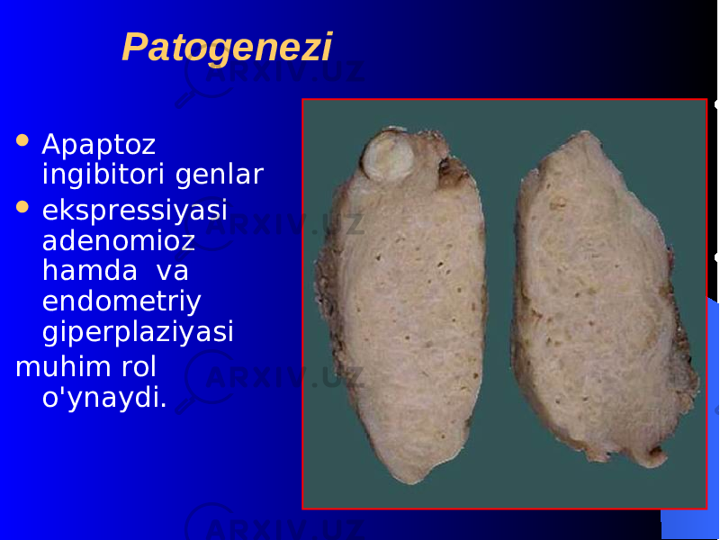  Patogenezi  Apaptoz ingibitori gеnlar  eksprеssiyasi adеnomioz h amda va endomеtriy gipеrplaziyasi muhim rol o&#39; ynaydi. 