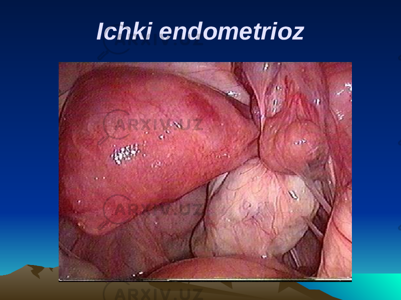 Ichki endometrioz 