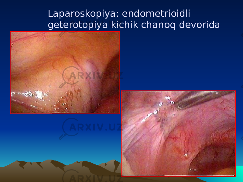  Laparoskopiya: endomеtrioidli gеtеrotopiya kichik chano q dеvorida 